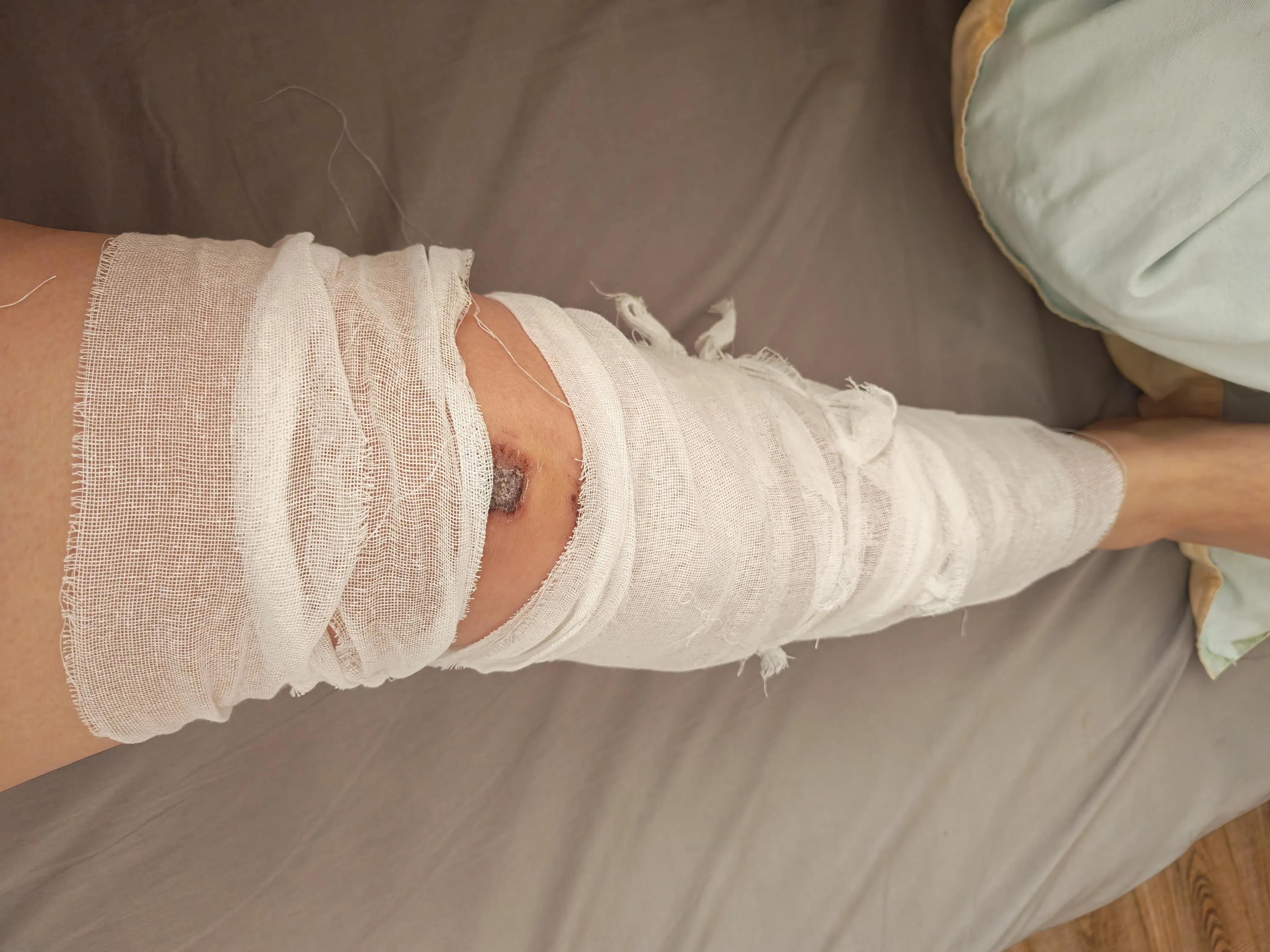 骨折躺床上没收入?分享真实踩坑经历,帮你避开骗局(图1) 骨折躺床上没收入?分享真实踩坑经历,帮你避开骗局(图1)